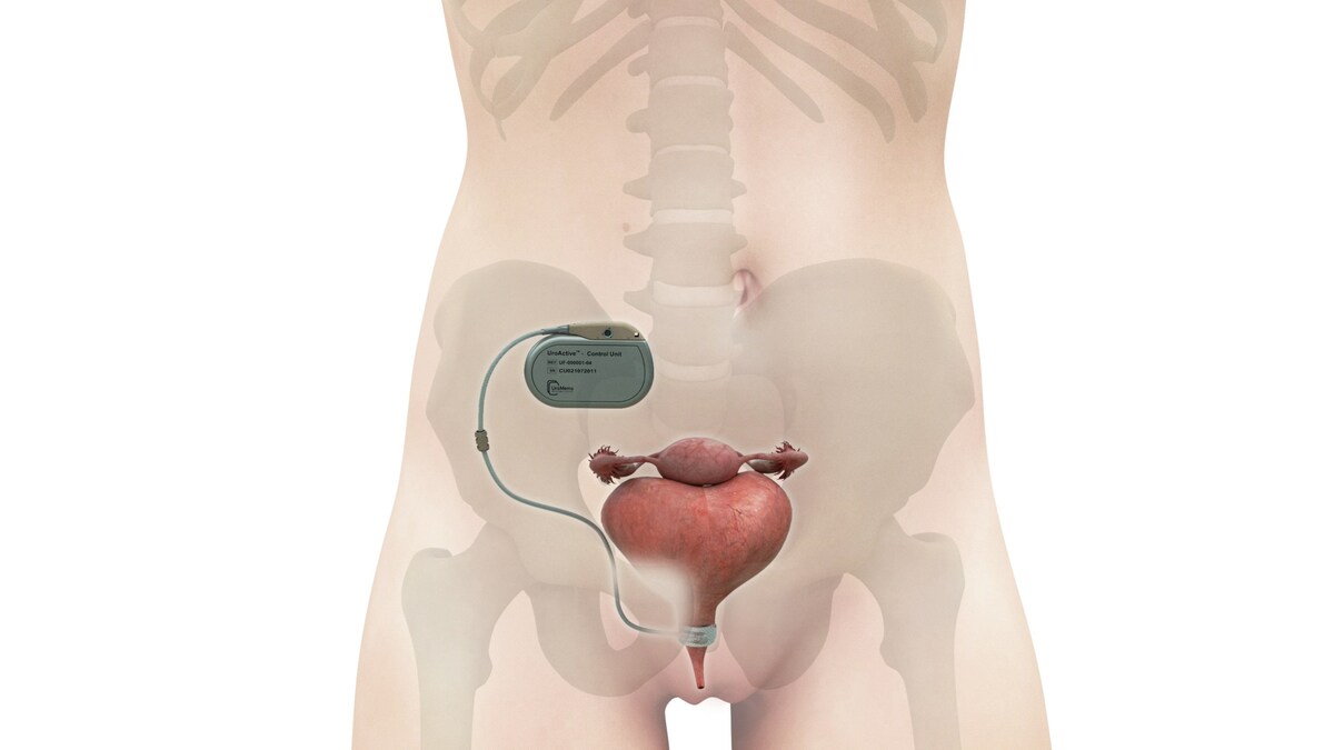 UroMems Announces First-Ever Smart Artificial Urinary Sphincter Implant in  a Female Patient