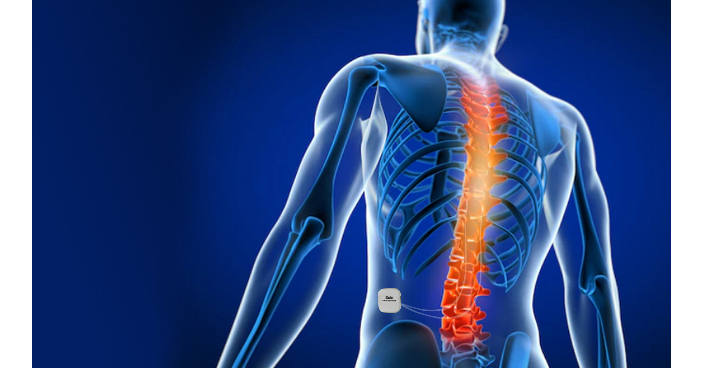 Soin Neuroscience Tests Very Low Frequency Spinal Cord Stimulation in Humans
