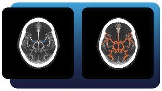 Aidoc's New Full Brain Solution Identifies Suspected Posterior and Anterior Large and Medium Vessel Occlusions in Addition to Aneurysms and Hemorrhages.