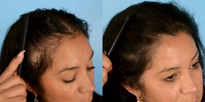 Before and after 3 Alma TED treatments at Bauman Medical