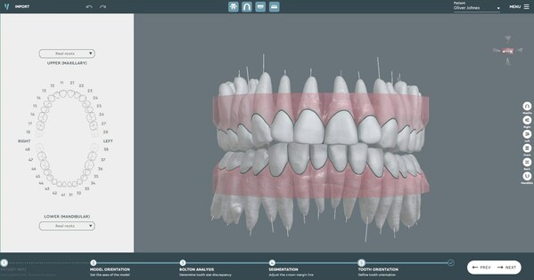 SoftSmile Unveils CBCT Integration in VISION, Its Flagship Clear Aligner Treatment Planning Software