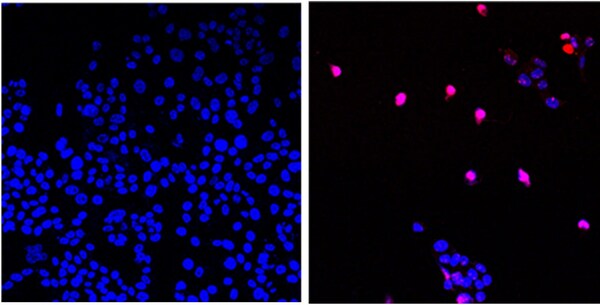 The City of Hope-developed small molecule AOH1996 targets a cancerous variant of the protein  PCNA. In its mutated form, PCNA is critical in DNA replication and repair of all expanding tumors. Here we see untreated cancer cells (left) and cancer cells treated with AOH1996 (right) undergoing programmed cell death (violet). (Photo credit: City of Hope)