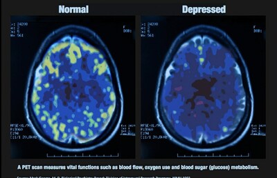 PET Scan Showing biological changes in psychiatric illness