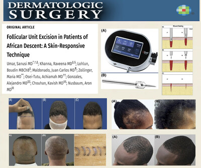 El nuevo dispositivo FUE de alta respuesta cutánea supone un paso importante para ofrecer una solución eficaz de restauración capilar a los afrodescendientes.