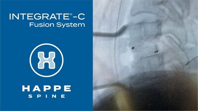 HAPPE Spine Integrate-C Fusion System