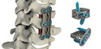 4WEB Medical Announces the Full Commercial Launch of its Cervical Spine Plating Solution