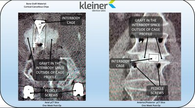 Scan images demonstrate the intervertebral graft fill in a case utilizing the new KG™ 2 Surge™ flow-thru interbody system, which allows implant placement, positioning, and grafting in a single surgical pass in TLIF and PLIF procedures.