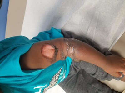 Kidz Biz Preparatory, a daycare center in Hazelwood, Missouri, is facing a lawsuit filed by the mother of an 18-month-old boy who suffered second-degree burns while at the facility in May 2019. Tiara Cornell claims the daycare center endangered her son's life when workers left a hot bottle warmer full of boiling water unsecured and unattended. The scalding hot water severely burned his arm.