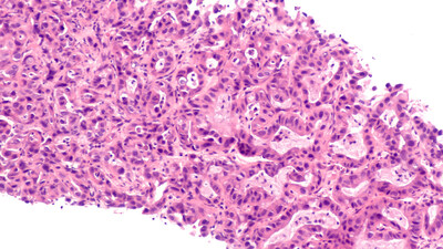Pancreatic cancer metastatic biopsy