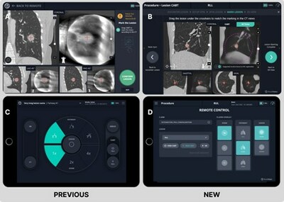 LungVision™ previous iteration C-Arm Based Tomography (CABT) imaging and remote screen (A,C) and v2.23 AI Tomography imaging, suggested lesion location feature and remote screen updates (B,D).