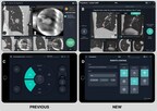 Body Vision Medical Introduces Latest Version of LungVision™ Software with Big Design Upgrade