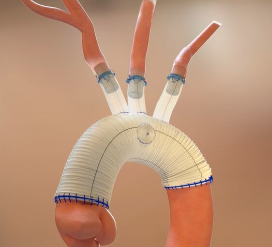 Aquedeon Medical, Inc. Receives FDA IDE Approval for the Duett Vascular Graft System - Vimarsana News