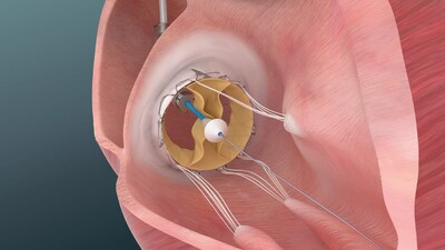 An illustration depicting Trisol valve deployment.