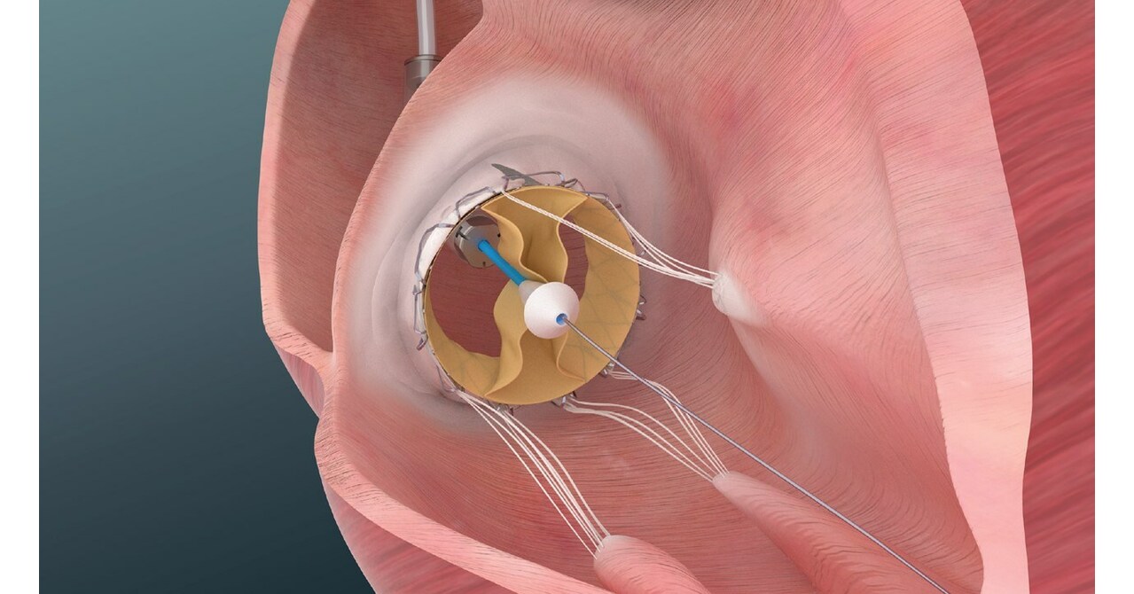 Trisol Medical Announces Positive Results from U.S. Early Feasibility Study of Its Transcatheter Tricuspid Valve Replacement System