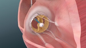 Trisol announces successful implants of its Transcatheter Tricuspid Valve in the US