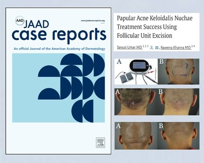 Tres pacientes con acné queloideo de la nuca (AKN) fueron tratados con éxito mediante FUE utilizando UGraft Zeus (PRNewsfoto/Dr. U Hair and Skin Clinic)