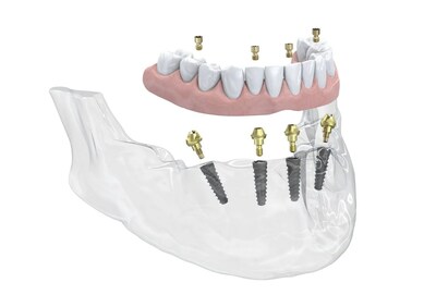  Neoss 4+ Treatment Solution using ProActive Edge implants and Multi-Unit Abutments in the mandible