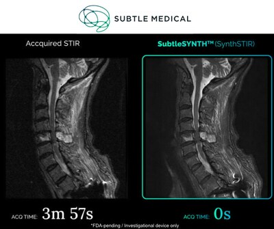 Spine STIR exam synthesized by SubtleSYNTH AI at 100% acceleration reducing the scan time from 3min 57sec to zero.