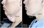 Example of the Five Layer Neck Lift Results