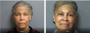 Aesthetic Plastic Surgery &amp; Laser Center Announces Fraxel Duo Laser's Effectiveness in Treating Melasma