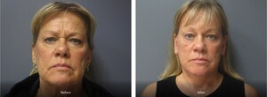 Aesthetic Plastic Surgery &amp; Laser Center Sees Rising Demand in Combined Facelift and Fat Grafting Procedures