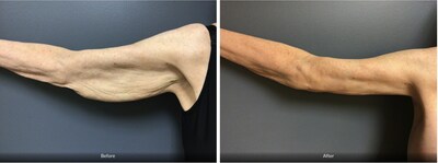 Before and After Arm Lift
