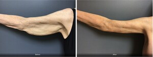 Aesthetic Plastic Surgery &amp; Laser Center Observes Rising Trend in Arm Lifts Following Weight Loss