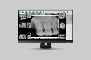 DEXIS Introduces DEXIS 10 Imaging Suite Software featuring the DEXassist Solution with AI-Enabled 2D Findings