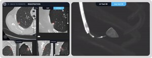 Body Vision Medical Latest Software Release Enhances LungVision™ System with Improved AI Tomography Imaging, Streamlined Workflow with Robots, and Reduced Radiation Dose