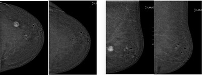 Poster images (supplied by IceCure) show mass enhancement in central outer left breast referable to B5 lesion and a slight central mass (fibroadenoma). Compared to post cryobalation, showing no mass enhancement in central outer breast, biopsy reported benign lesion (flogosis).