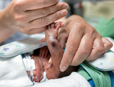 Anonymous Baby Boy: 
Born at 27 weeks and just over 700 grams, this baby needed a lifesaving infusion a few days after birth. A therapy that is supposed to help instead left a painful spot - and because of the infiltration, this precious infusion was largely ineffective.