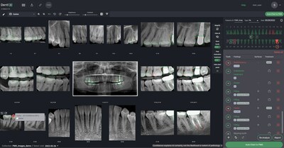 Illustration of Combined Denti.AI Detect and Auto-Chart Features