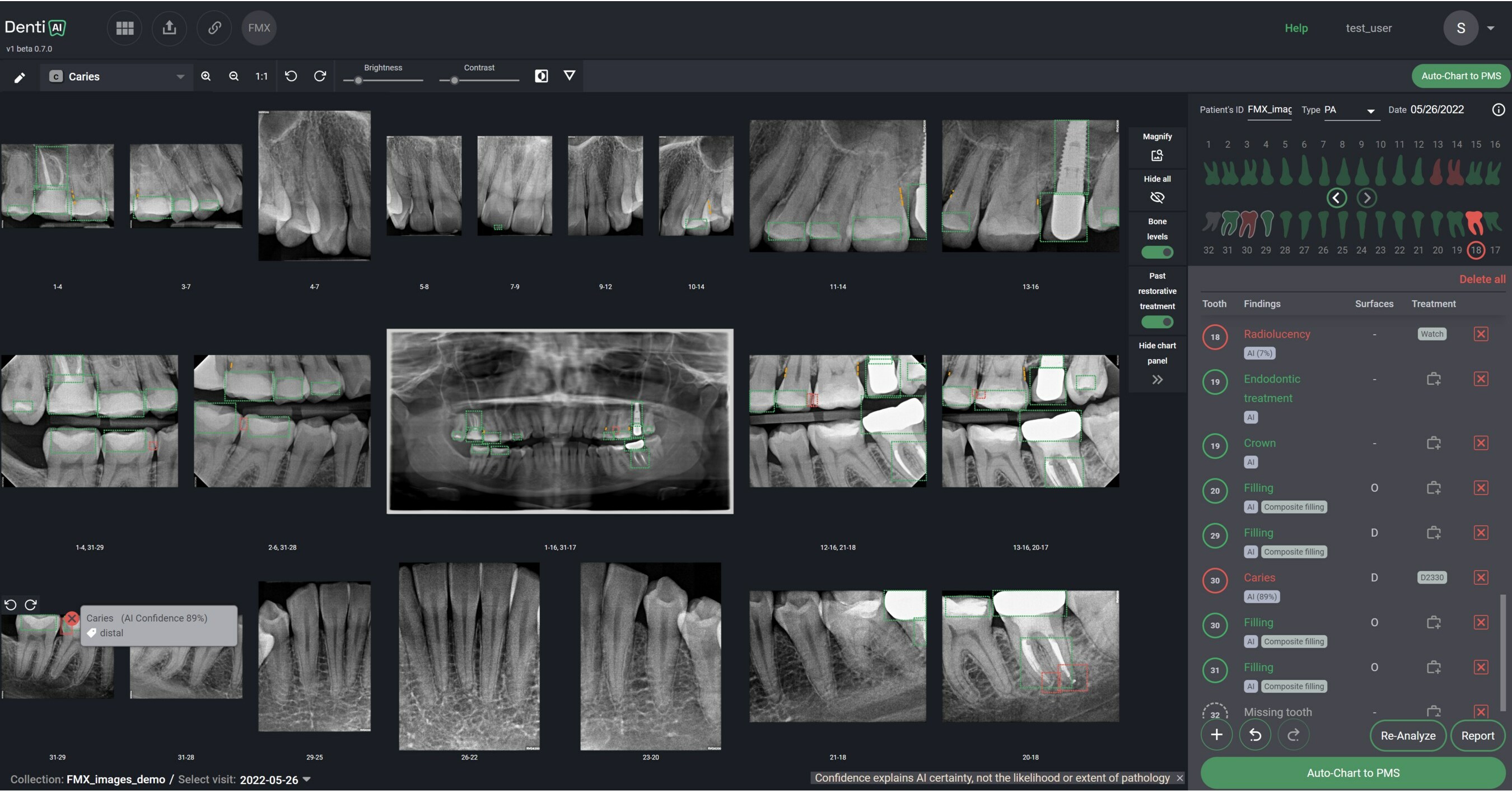 DENTI.AI PIONEERS FDA-CLEARED PATHOLOGY DETECTION IN BOTH PANORAMIC AND INTRAORAL X-RAYS WITH LAUNCH OF DENTI.AI DETECT