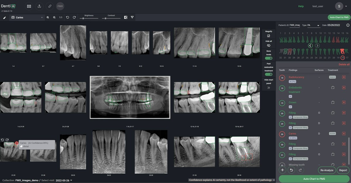 DENTI.AI PIONEERS FDA-CLEARED PATHOLOGY DETECTION IN BOTH PANORAMIC AND INTRAORAL X-RAYS WITH LAUNCH OF DENTI.AI DETECT - Vimarsana News