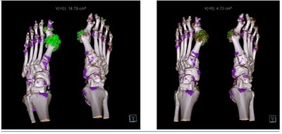 Arthrosi to Present Positive Phase 2 Data for its Novel Selective 