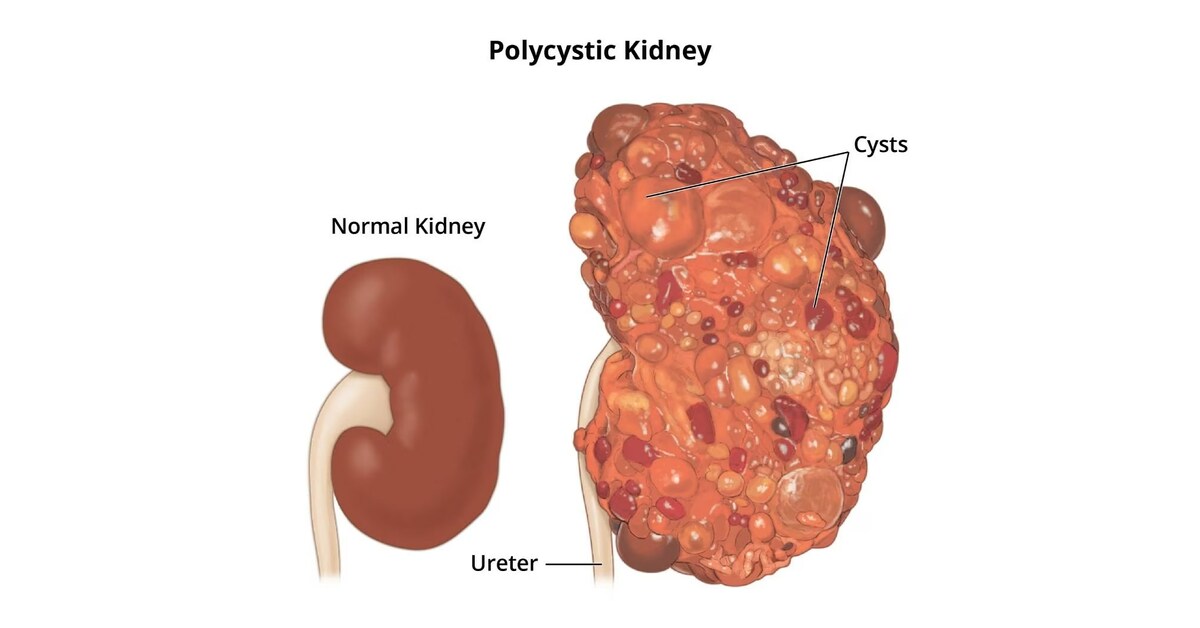 PYC'S FOURTH DRUG CANDIDATE HAS DISEASE-MODIFYING POTENTIAL IN ...