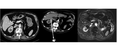 Left - 85-year-old man with 3 cm biopsy-proven clear cell renal carcinoma. Middle - CT showing IceCure cryoprobe in tumor with final ice ball. Right - MRI at 1 month, demonstrating complete local response, no evidence of tumor enhancement