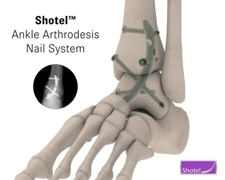 New Shotel™ Medical Ankle Arthrodesis DeviceSignificantly Improves Patient Quality of Life - Vimarsana News
