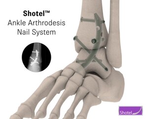 New Shotel™ Medical Ankle Arthrodesis Device Significantly Improves Patient Quality of Life