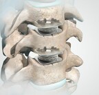 DISC Surgery Center at Newport Beach Now Enrolling Patients in Clinical Study on Artificial Disc Replacement