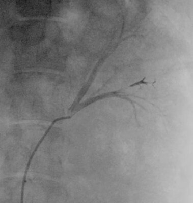 ULTRA Embolic blocks vessel