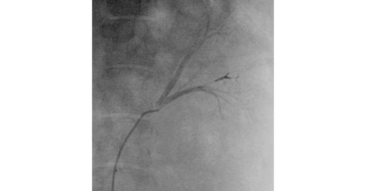 Fluidx Medical Reveals New Embolic Platform for Internal Bleeding, Tumor Treatment, and Other Uses