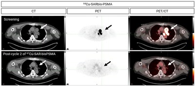 Figure_1_PET_CT_images_showing_uptake_Cu_64_SAR_bisPSMA_screening.jpg