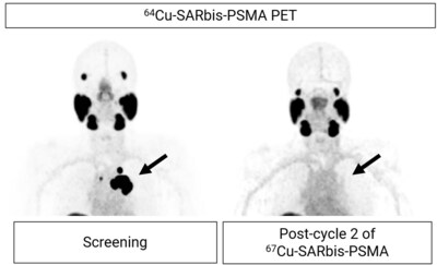Figure 2. PET images showing uptake of Cu-64 SAR-bisPSMA at screening in a patient with mCRPC (left; SUVmax 140.1. SUV: standardised uptake value). The patient received 2 cycles of Cu-67 SAR-bisPSMA at 8 GBq. Images post-treatment show no Cu-64 SAR-bisPSMA uptake (right).