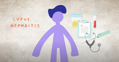 The National Kidney Foundation has launched a new four-part patient-friendly animated video series to educate and help patients from diverse backgrounds and with varying levels of health literacy better understand the link between systemic lupus erythematosus (SLE) and lupus nephritis (LN).