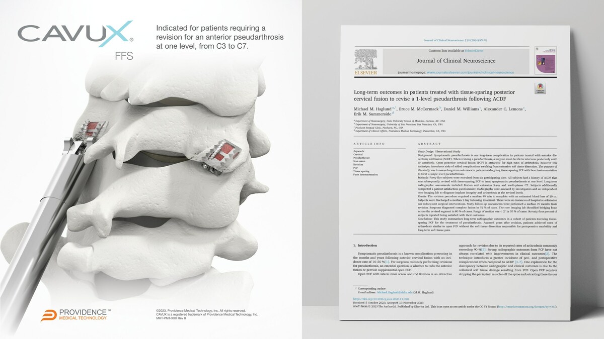 Providence Medical Technology Announces New Publication Demonstrating High Fusion Rates and Successful Outcomes in Previously Failed Cervical Fusion Patients - Vimarsana News