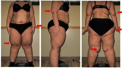 A photo of a woman with lipedema Type 3 Stage 3 views from front, back, and sides show characteristic skin changes. In the first frontal view (A), notice the mattress changes in the thighs; the red arrows point at the wrist cuff and tissue overhanging the knees. In the second panel (B), the arrow is pointed at arm lobule. In the third panel (C), the red arrows point at lobules on the upper arms, hips, and inner knees. Lipedema is commonly misdiagnosed as obesity.