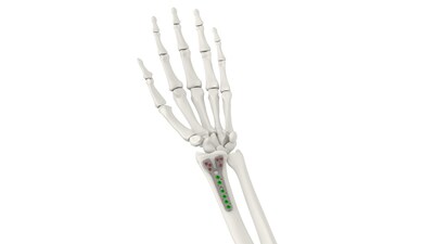 Tyber Medical Distal Radius Plating System, Setting New Standards in Orthopedic Care
