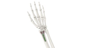 Tyber Medical Granted FDA Clearance on Distal Radius Plating System