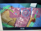 World's first pediatric deformity case using immersive augmented reality surgical navigation